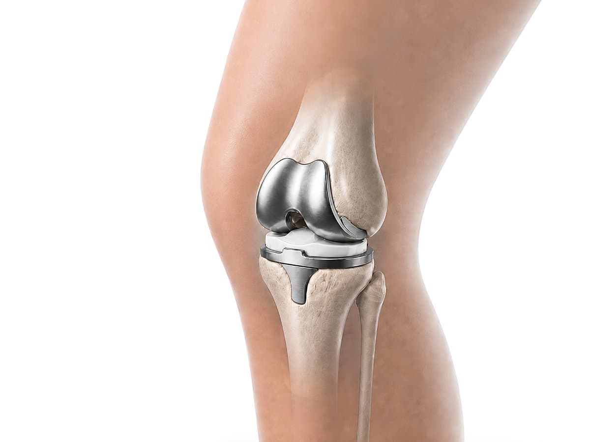 Rodilla