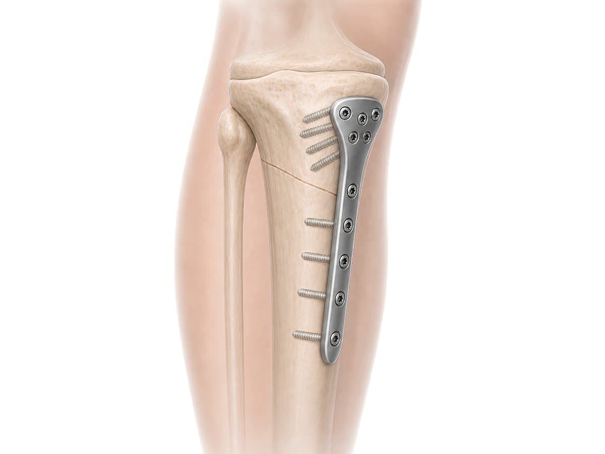 Osteosíntesis